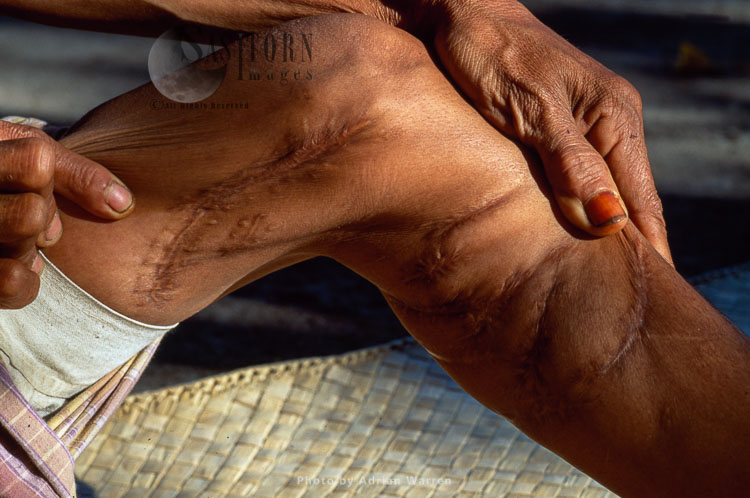 Leg Injuries bitten by Komodo Dragon, Island of Rinca, Near Komodo, Indonesia